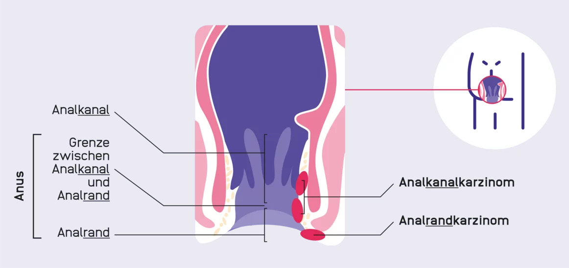 Illustration des Analkanals und betroffener Bereiche
