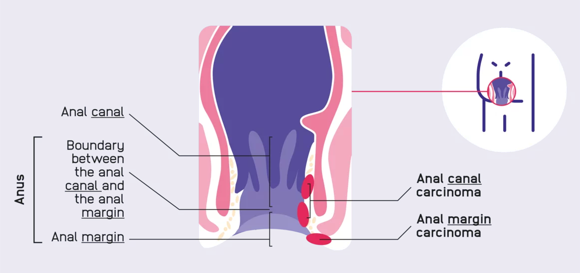 Illustration of anal canal structure and disease areas
